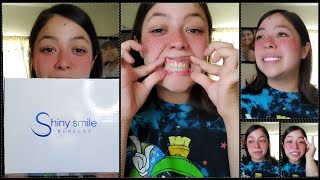 Shiny Smile Veneers Review Gone Wrong [upl. by Leimad]