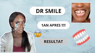 TRAITEMENT DR SMILE 1AN APRÈS JE RÉPONDS À VOS QUESTIONS 😁 [upl. by Des601]