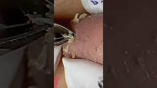 Skincare  Blackheads Removal 173 skincare skincare blackheads blackheads [upl. by Ainessey]