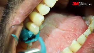 TripleTray technique for posterior Impressions using 3M Monophase [upl. by Zapot]