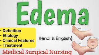 Edema  Edema In Hindi  Oedema [upl. by Jer]