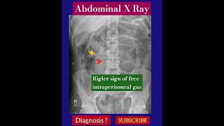 Rigler sign of free intraperitoneal gas  Diagnosis   Abdominal X Ray  Radiology [upl. by Hartill]