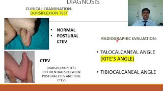 Congenital Talipes Equino Varus CTEV  Rapid Revision of Orthopaedics by Dr Prateek Joshi [upl. by Petersen]