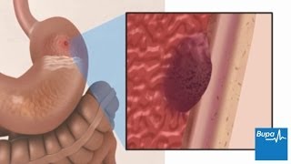 How a peptic ulcer develops  Bupa Health [upl. by Rabin106]