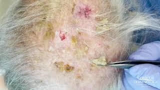 Debulking Lesions on the Scalp Erosive Pustulosis of the Scalp  CONTOUR DERMATOLOGY [upl. by Myca864]