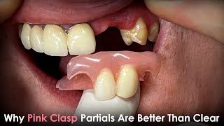 Why Pink Clasp Partials Are Better Than Clear Clasp Partials [upl. by Eenhpad]