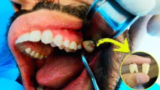 Extração de 2 dentes do Siso em 2 minutos  Procedimento Completo [upl. by Areikahs]