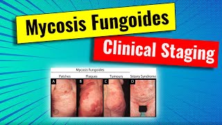 Staging of Mycosis fungoides MF  video series for dermatology residency and USMLE [upl. by Nairb]