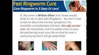 How To Get Rid of Ringworm Fast  How to Cure Ringworm Fast [upl. by Pachston]