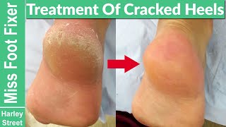 Satisfying callus heel foot scraping  cracked heels  Fissures Foot fixer Marion Yau [upl. by Rubio]