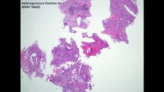 Pathology and Immunohistochemistry in Guiding Systemic Treatment of Advanced Cutaneous Malignancy [upl. by Eelyr]