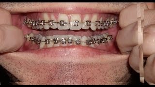 Braces  Photo taken every day  Before and After Transformation  Orthodontics Timelapse [upl. by Anon496]