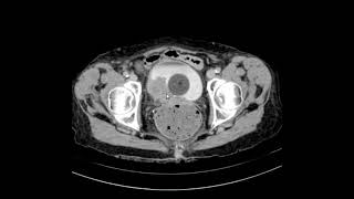 Carcinoma urotelial da bexiga [upl. by Eniarrol]