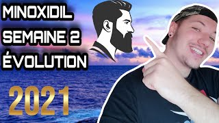 MINOXIDIL  1 ANS POUR DEVENIR BARBU SEMAINE 2 [upl. by Neille]