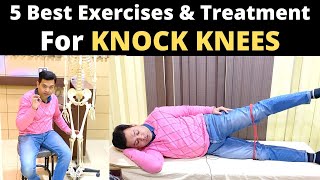 Knock Knee Treatment Genu Valgum knock knees correction exercise How to treat knock knees [upl. by Mauro]