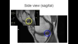 How to Read Knee MRI of Torn Meniscus  Meniscal Tear  Santa Fe Albuquerque Orthopedic Surgeon [upl. by Puto]