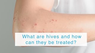 What causes Cold Hives amp how to manage it  Dr Urmila Nischal [upl. by Nahtal616]