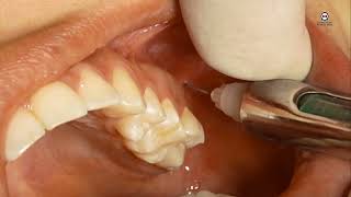 Técnica de la Tuberosidad o para el Nervio Alveolar Superior Posterior [upl. by Odlabu]