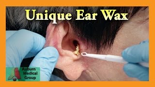 Eight Ear Washes  Auburn Medical Group [upl. by Kessler]