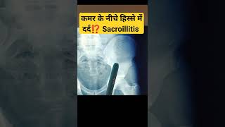 Sacroiliitis Pain in Young 🔥🔥 कमर के नीचे हिस्से में दर्द की समस्या sacroileitis sacroiliacjoint [upl. by Fortunato463]