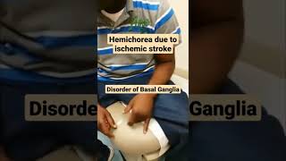 Hemichorea Disorder of Basal Ganglia mbbs neet medicine neetpg usmle [upl. by Meuse]