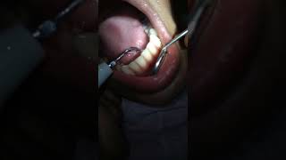 scaling of teeth  dentist removes all the plaque and tartar scaling plaque happyday dentalcare [upl. by Kilmarx]