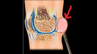 Bakers Cyst its relationship to meniscus tears and knee arthritis [upl. by Gurias]