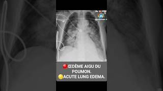 chest xray doctor radiographie thoracique [upl. by Ultun]