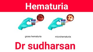 Approach To Hematuria  Types amp Management Dr Sudharsan [upl. by Nehtanoj]