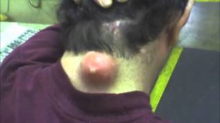 Worlds Biggest Pimple Popped World Record Holder 2012 [upl. by Ferri]