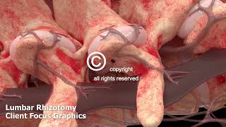 Lumbar Rhizotomy Animation [upl. by Loziram]