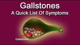 Gallstones A Quick List Of Symptoms [upl. by Shlomo]