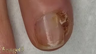 😨 UNHA DA MÃO TAMBÉM ENCRAVA satisfying ingrowntoenail [upl. by Ekard132]