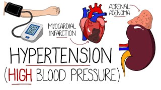 Hypertension Explained High Blood Pressure  Includes Hypertensive Emergency amp NICE Guidelines [upl. by Aiem482]