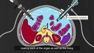 Pressurized Intraperitoneal Aerosol Chemotherapy PIPAC  Peritoneal Carcinomatosis Patients [upl. by Kelton]