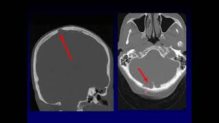 Head to Head Skull lesion [upl. by Abbi]