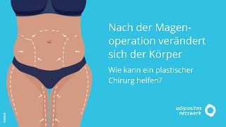 Nach der Magenoperation verändert sich der Körper Wie kann ein plastischer Chirurg helfen [upl. by Akenor]