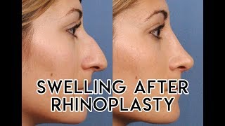 Swelling After Rhinoplasty [upl. by Bajaj]