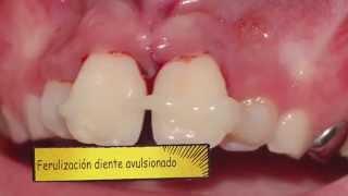 Avulsion dental en diente permanente [upl. by Dara]