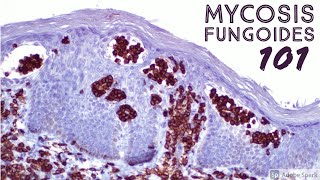 Mycosis Fungoides 101 Cutaneous Tcell Lymphoma CTCL for Dermatopathology Pathology Dermatology [upl. by Belldame]