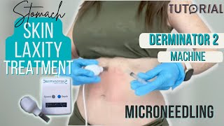 LOOSE STOMACH SKIN TIGHTENING GUIDE  Derminator 2 Microneedling [upl. by Euqina]