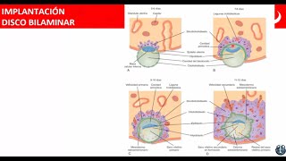 Implantación Disco Bilaminar [upl. by Ajax]