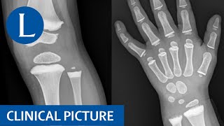 Metaphyseal sclerosis in a child with a giant cell tumour treated with denosumab [upl. by Aphrodite]