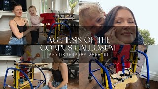 Agenesis of the Corpus Callosum  Physiotherapy Updates [upl. by Donovan]