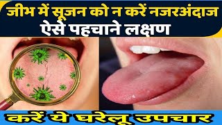 जीभ में सूजन के कारण लक्षण व् इलाज  Glossitis Treatment  Glossitis Tongue । By Dr Sanjay Gupta । [upl. by Elletnuahc]