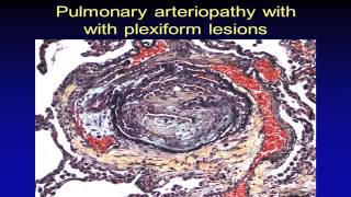 Pulmonary Hypertension Pathology [upl. by Saidel]