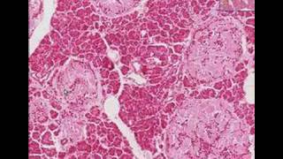 Histopathology Pancreas Type 2 Diabetes mellitus [upl. by Matthus276]