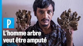 « Lhomme arbre » ne veut plus de ses mains [upl. by Attenaj]