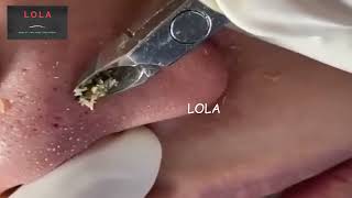 Most Relaxing Satisfying Enjoyable Pluck Acne with Tweezer 06 Stress Reliever [upl. by Ynamad780]