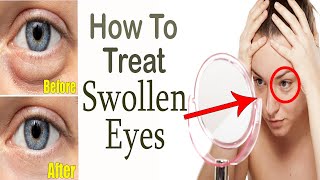 How to Get Rid of Swollen Eyes at Home  Home Remedies for Swollen Eyes  Puffy Eyes Treatment [upl. by Azalea]